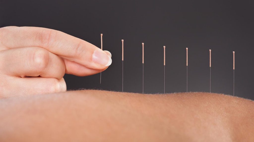 All you need to know about Acupuncture